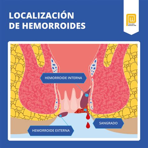 Hemorroides