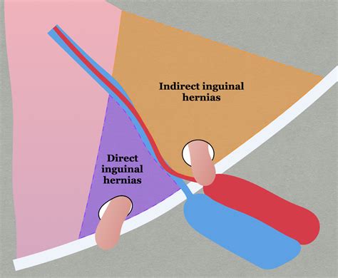 Hernia Inguinal