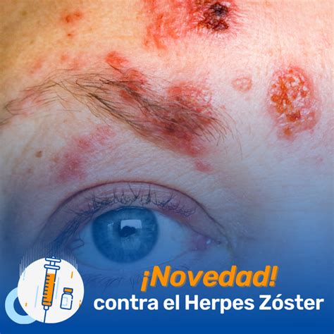 Herpes Zóster