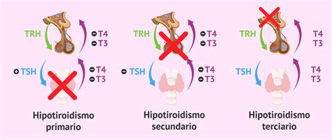 Hipotiroidismo