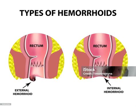 Ilustración de hemorroides internas y externas