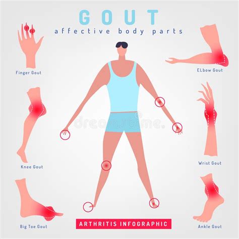Ilustración del dolor gotoso