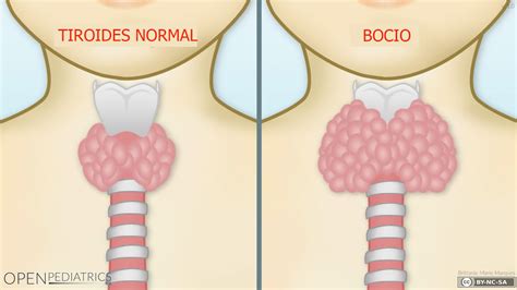 Imagen de un bocio tiroideo