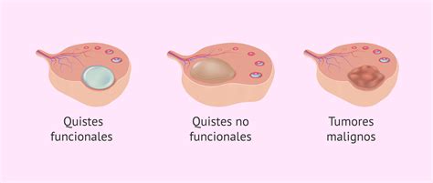 Imagen ilustrativa de quistes en los ovarios