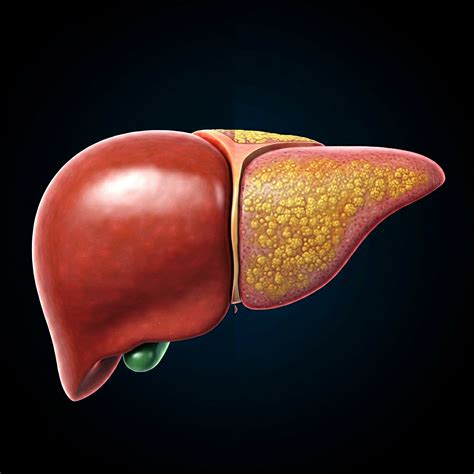 Imagen ilustrativa del hígado graso no alcohólico