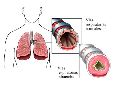 Inflamación de las vías respiratorias en el asma