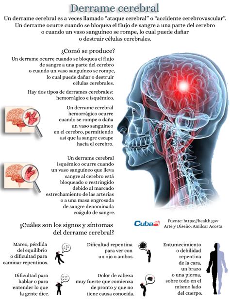 Infografía sobre el derrame cerebral