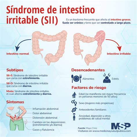 Infografía sobre el síndrome del intestino irritable