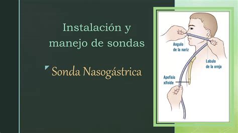 Instalación de Sonda Nasogástrica a Domicilio