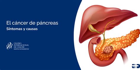 Investigación sobre cáncer de páncreas y dieta cetogénica