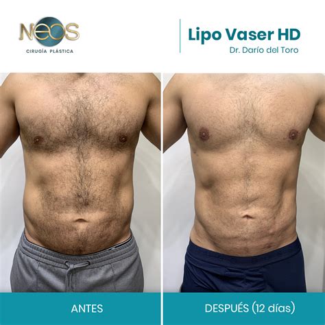 Lipoescultura 4 en 1