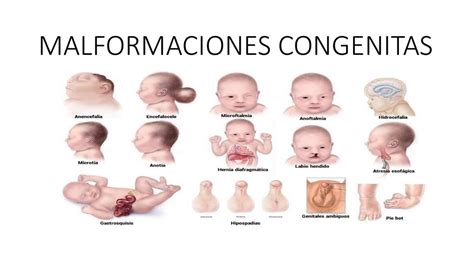 Malformaciones congénitas
