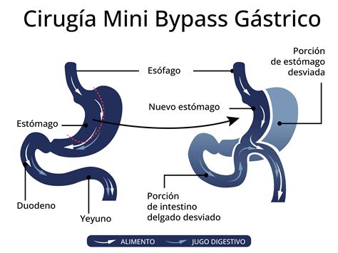 Mini Bypass Gástrico Bandeado con MiniMIZER