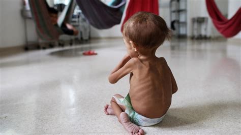 Niño con Desnutrición