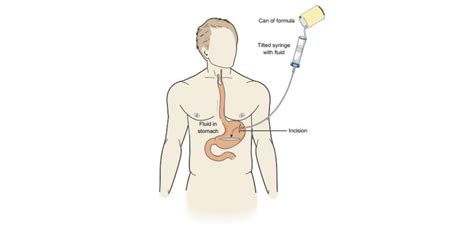 Nutrición Enteral