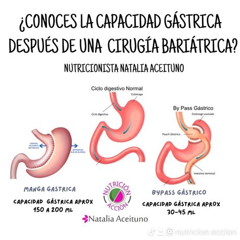 Opciones de Cirugía Bariátrica
