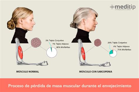 Pérdida de masa muscular con la edad