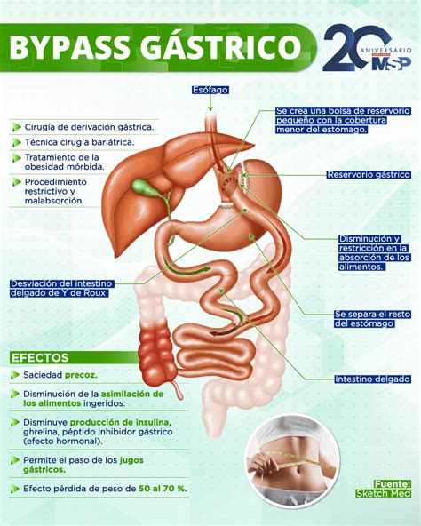 Píldora imitando bypass gástrico