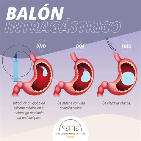 Proceso del Balón Intragástrico