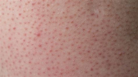Queratosis Pilaris