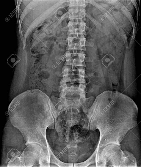Radiografía de columna