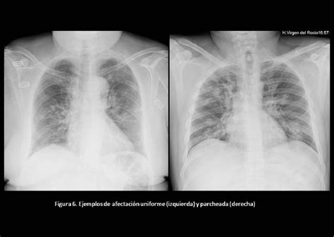 Radiografía de tórax mostrando neumonía