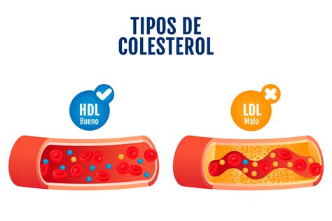 Reducción del Colesterol LDL con Orlistat