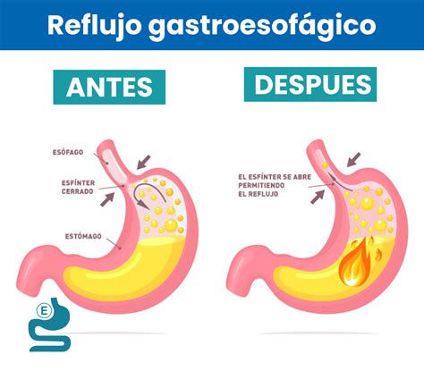 Reflujo Gastroesofágico