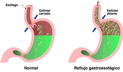 Reflujo gastroesofágico