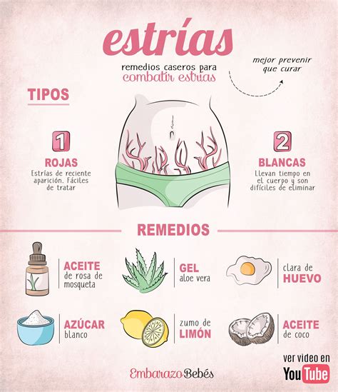 Remedios caseros para las estrías