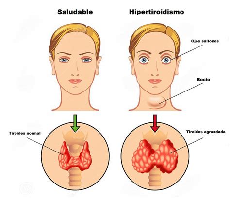Representación gráfica de la glándula tiroides y los efectos del hipotiroidismo