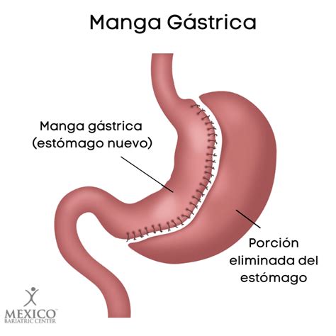 Representación gráfica de la manga gástrica