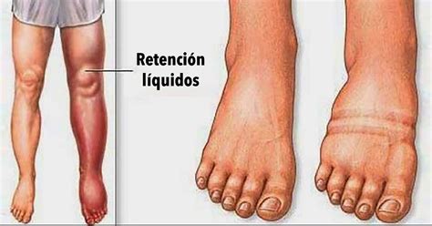 Retención de líquidos en pies y tobillos