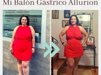 Romina Sáez antes y después del balón gástrico