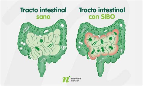 Síntomas del SIBO