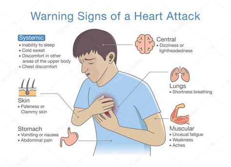 Signos de un ataque al corazón