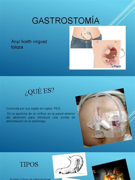 Tabla V. Comparación entre técnicas de gastrostomía