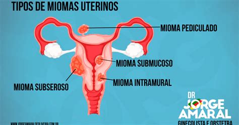 Tipos de Miomas Uterinos