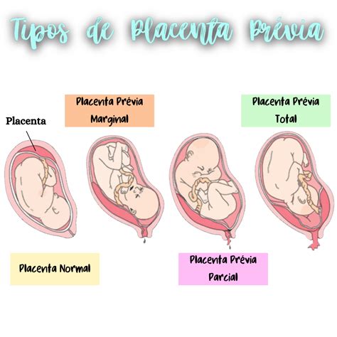 Tipos de Placenta Previa