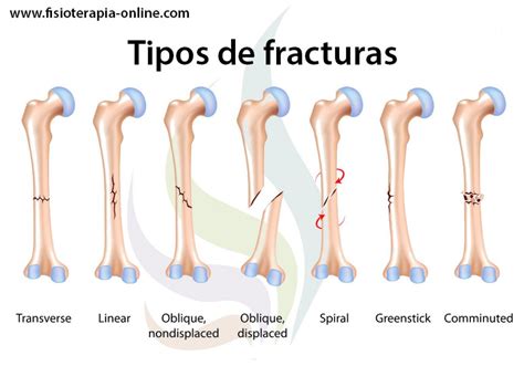 Tipos de fracturas óseas