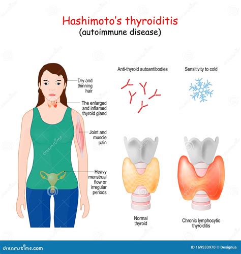 Tiroiditis de Hashimoto