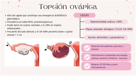 Torsión Ovárica