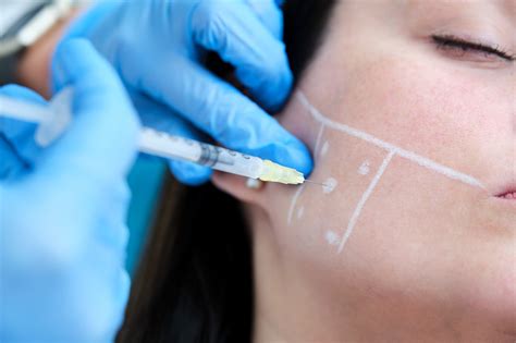 Toxina botulínica para bruxismo