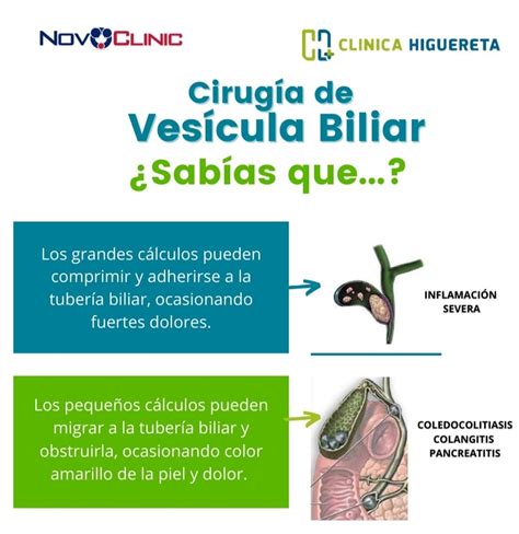 Vesícula Biliar y Colecistectomía